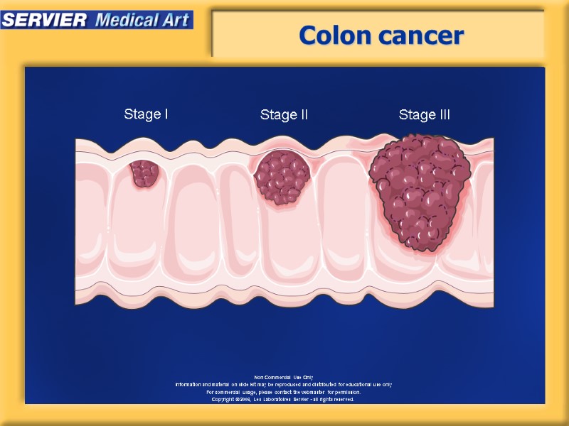 Colon cancer Stage I Stage II Stage III
